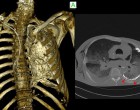 12.一具经过防腐处理的人体尸体骨骼系统的计算机断层摄影(CT)成像质量