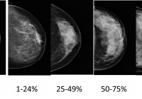 乳房X线摄影和乳房密度