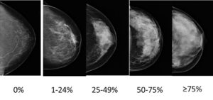 乳房X线摄影和胸胸密度