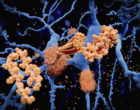 阿尔茨海默病：淀粉样蛋白β肽积聚在淀粉样蛋白原纤维中，该淀粉样蛋白胶质斑块。