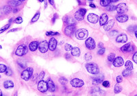 甲状腺癌的组织病理学图像