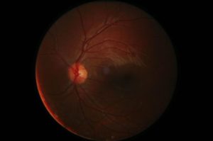糖尿病性视网膜病的早期检测对于防止视力丧失至关重要。